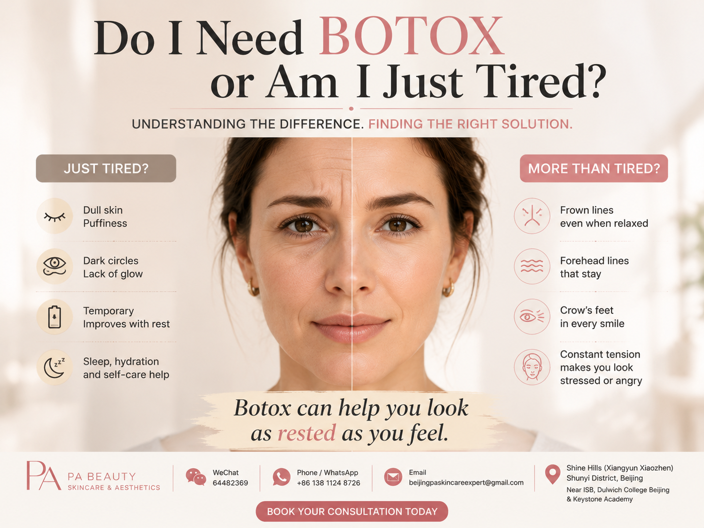 Do I need Botox or am I just tired? Understanding facial wrinkles, tired appearance, and natural Botox treatment at PA BEAUTY Beijing Do I need Botox or am I just tired? Understanding facial wrinkles, tired appearance, and natural Botox treatment at PA BEAUTY Beijing