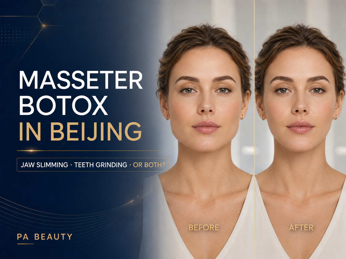 Masseter Botox in Beijing: Jaw Slimming, Teeth Grinding or Both? Masseter Botox in Beijing: Jaw Slimming, Teeth Grinding or Both?