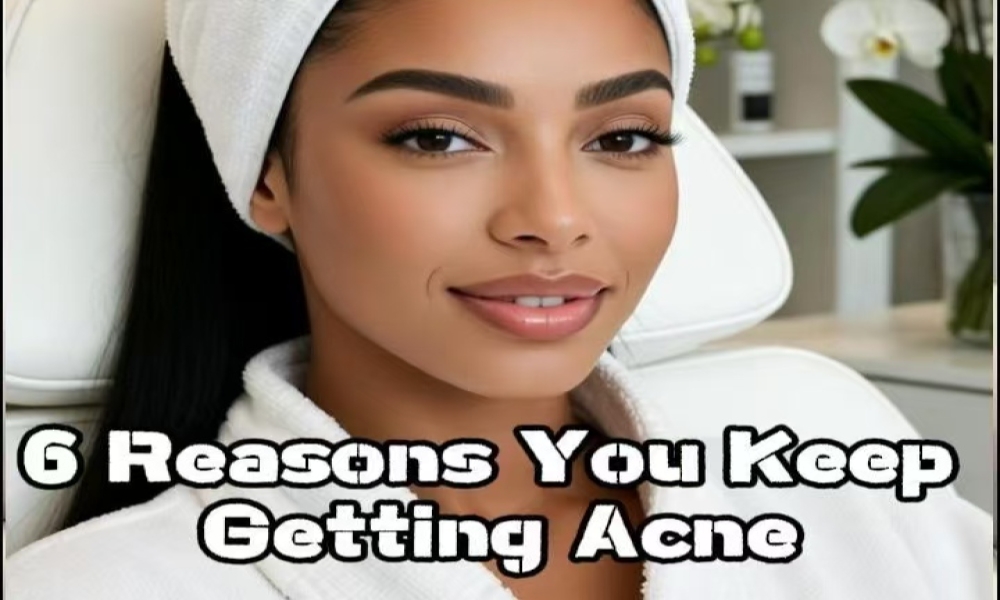 6 Reasons You Keep Getting Acne