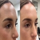 Botox in Beijing (For Expats) | Natural Results, No Frozen Look