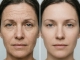 Botox Myths Busted: The Truth About Anti-Wrinkle Treatments at PA BEAUTY