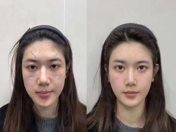 Cheek Area Rejuvenation Fill