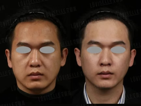 Sculptra® Collagen Biostimulator 