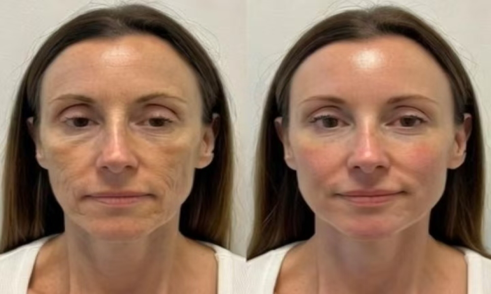 What Is Whole Face Rejuvenation?